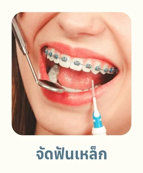 จัดฟันเหล็ก
