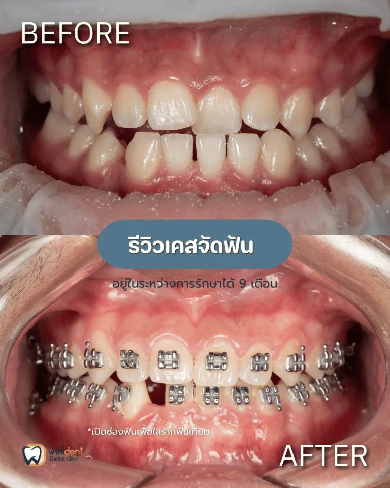 รีวิวผลลัพธ์ก่อน-หลัง Welldent Dental Clinic