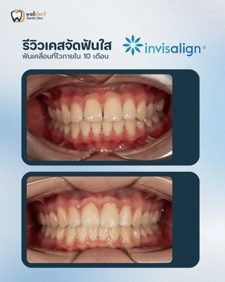 รีวิวผลการรักษา ราคาจัดฟันใส เท่าไร? ทำไมแต่ละคนราคาไม่เท่ากัน และควรเลือกแบบไหนให้เหมาะกับตัวเอง