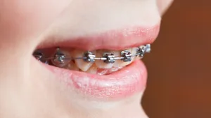 ราคาจัดฟันแบบ Self-Ligating แตกต่างจากจัดฟันโลหะเพราะอะไร? ทำความเข้าใจก่อนเลือกจัดฟันที่เหมาะกับคุณ
