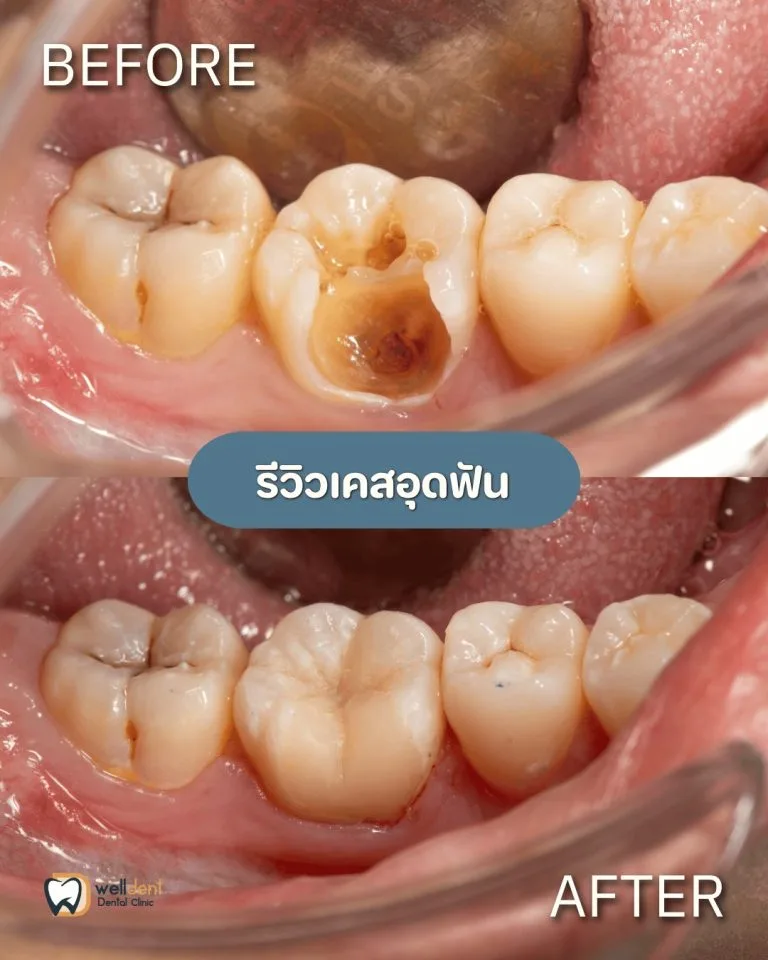 รีวิวผลการรักษา ฟันผุแบบไหนควรอุด และหากปล่อยไว้จะเกิดอะไรขึ้น