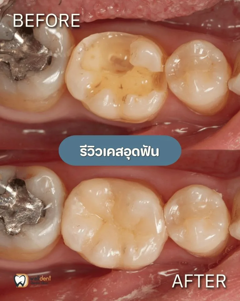 รีวิวผลการรักษา ฟันผุแบบไหนควรอุด และหากปล่อยไว้จะเกิดอะไรขึ้น