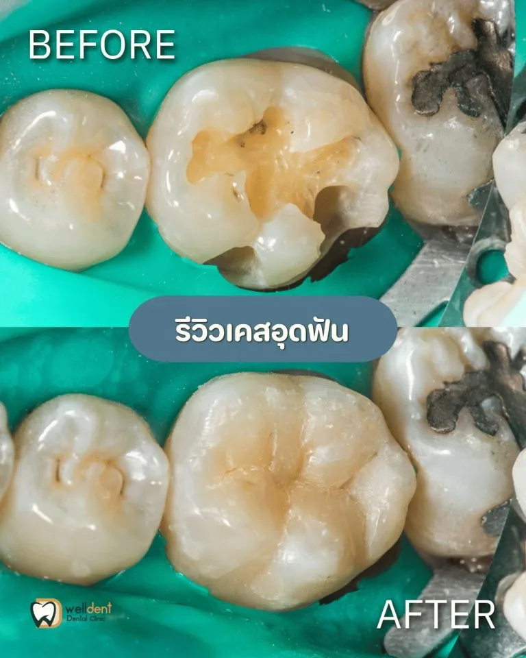 รีวิวผลการรักษา ฟันผุแบบไหนควรอุด และหากปล่อยไว้จะเกิดอะไรขึ้น