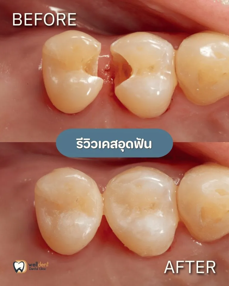 รีวิวผลการรักษา ฟันผุแบบไหนควรอุด และหากปล่อยไว้จะเกิดอะไรขึ้น