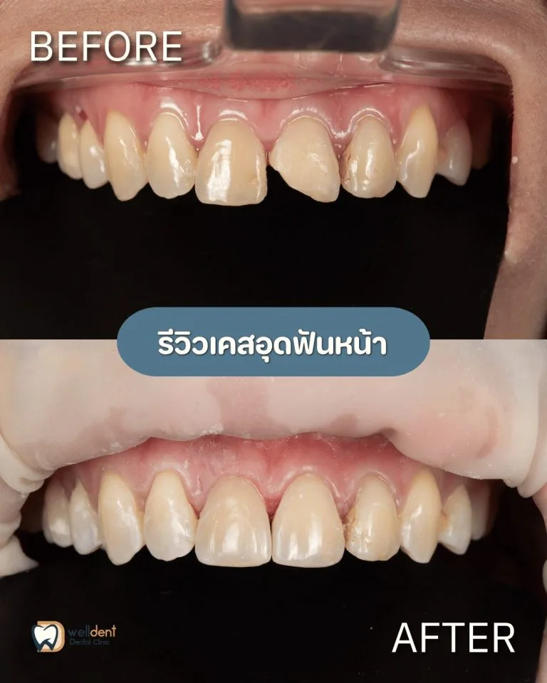 รีวิวผลการรักษา ฟันผุแบบไหนควรอุด และหากปล่อยไว้จะเกิดอะไรขึ้น