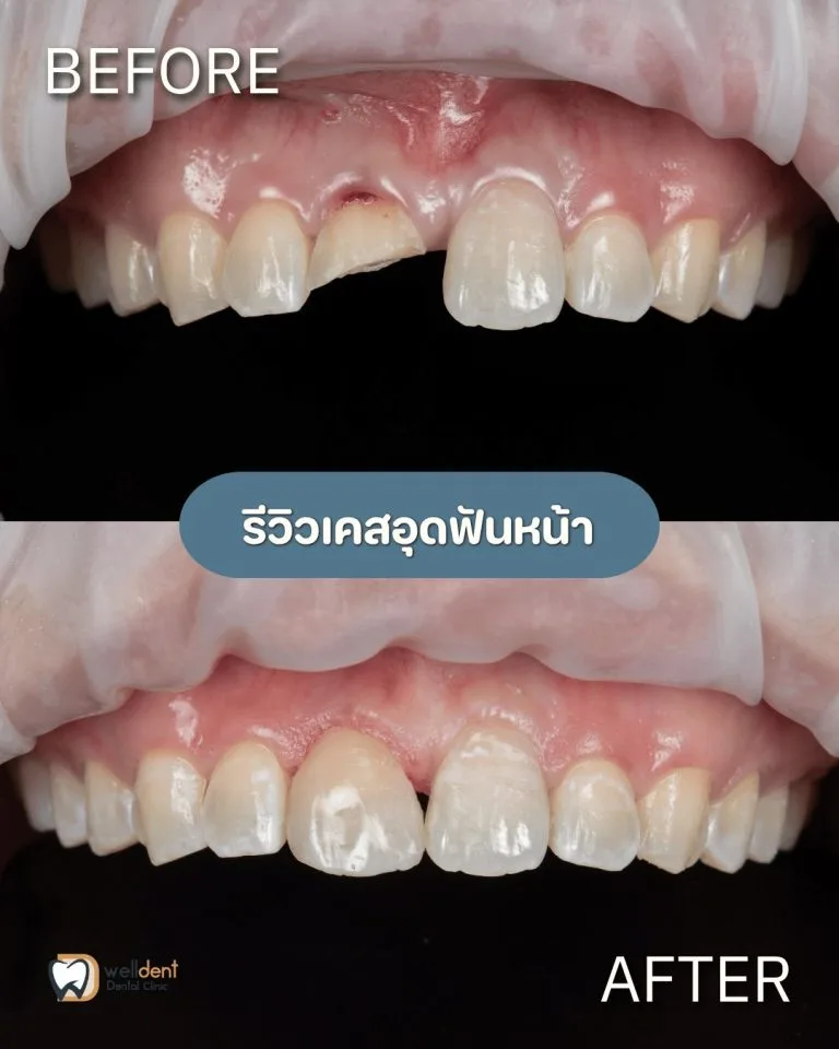 รีวิวผลการรักษา ฟันผุแบบไหนควรอุด และหากปล่อยไว้จะเกิดอะไรขึ้น
