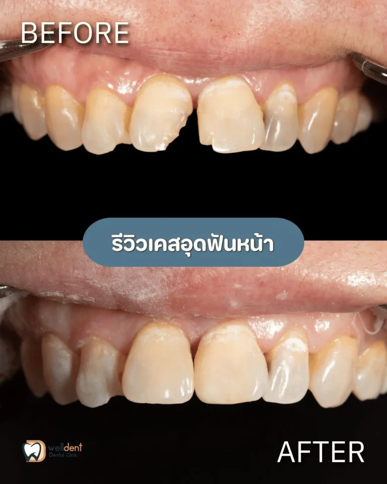 รีวิวผลการรักษา ฟันผุแบบไหนควรอุด และหากปล่อยไว้จะเกิดอะไรขึ้น