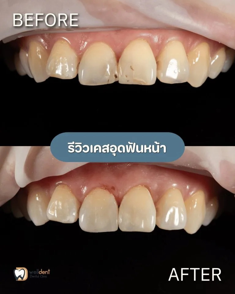 รีวิวผลการรักษา ฟันผุแบบไหนควรอุด และหากปล่อยไว้จะเกิดอะไรขึ้น