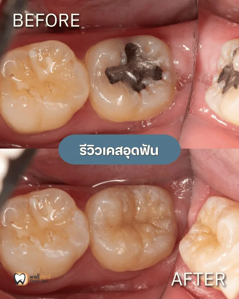 รีวิวผลการรักษา ฟันผุแบบไหนควรอุด และหากปล่อยไว้จะเกิดอะไรขึ้น
