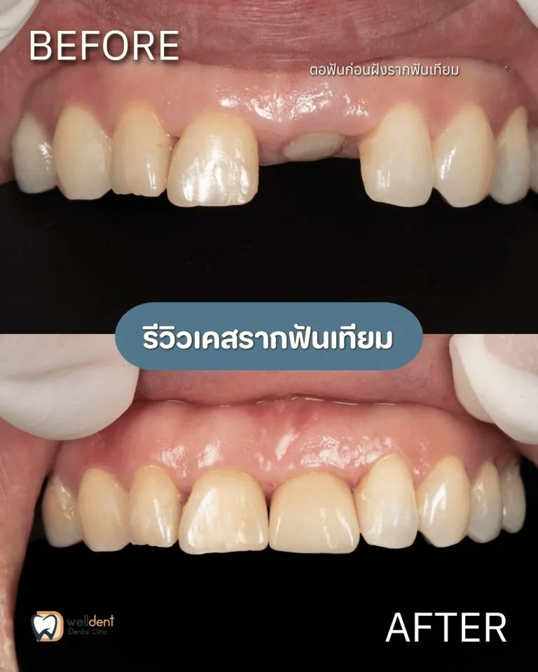 รีวิวผลการรักษา รากฟันเทียม Nuvo, Neodent และ Straumann ต่างกันอย่างไร? เลือกแบบไหนให้เหมาะกับตัวเอง