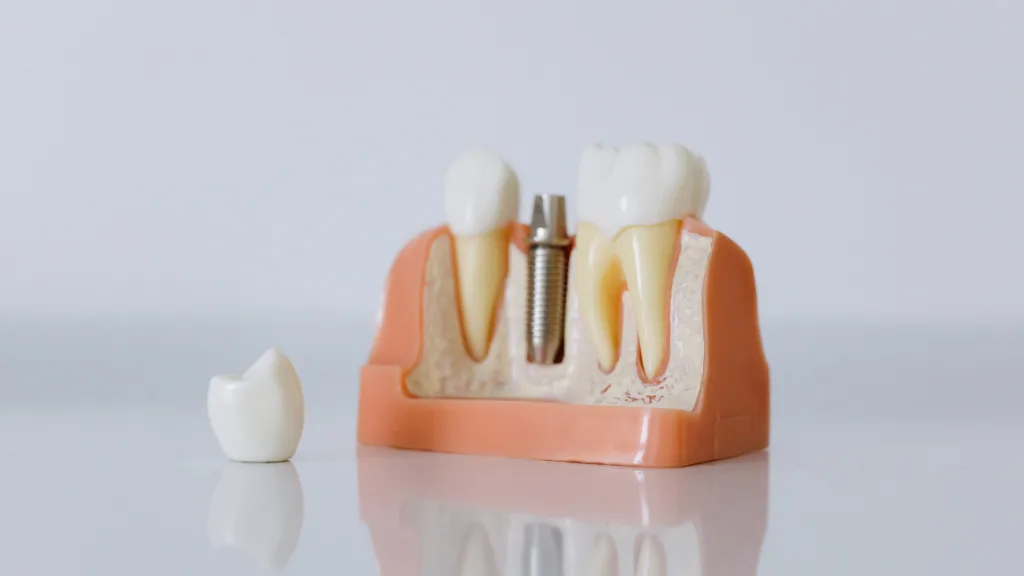 รากฟันเทียม Nuvo, Neodent และ Straumann ต่างกันอย่างไร? เลือกแบบไหนให้เหมาะกับตัวเอง