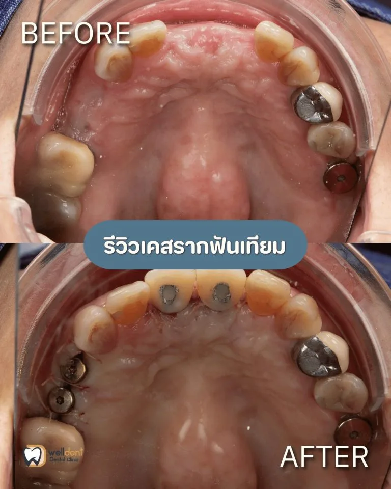 รีวิวผลการรักษา รากฟันเทียม Nuvo, Neodent และ Straumann ต่างกันอย่างไร? เลือกแบบไหนให้เหมาะกับตัวเอง