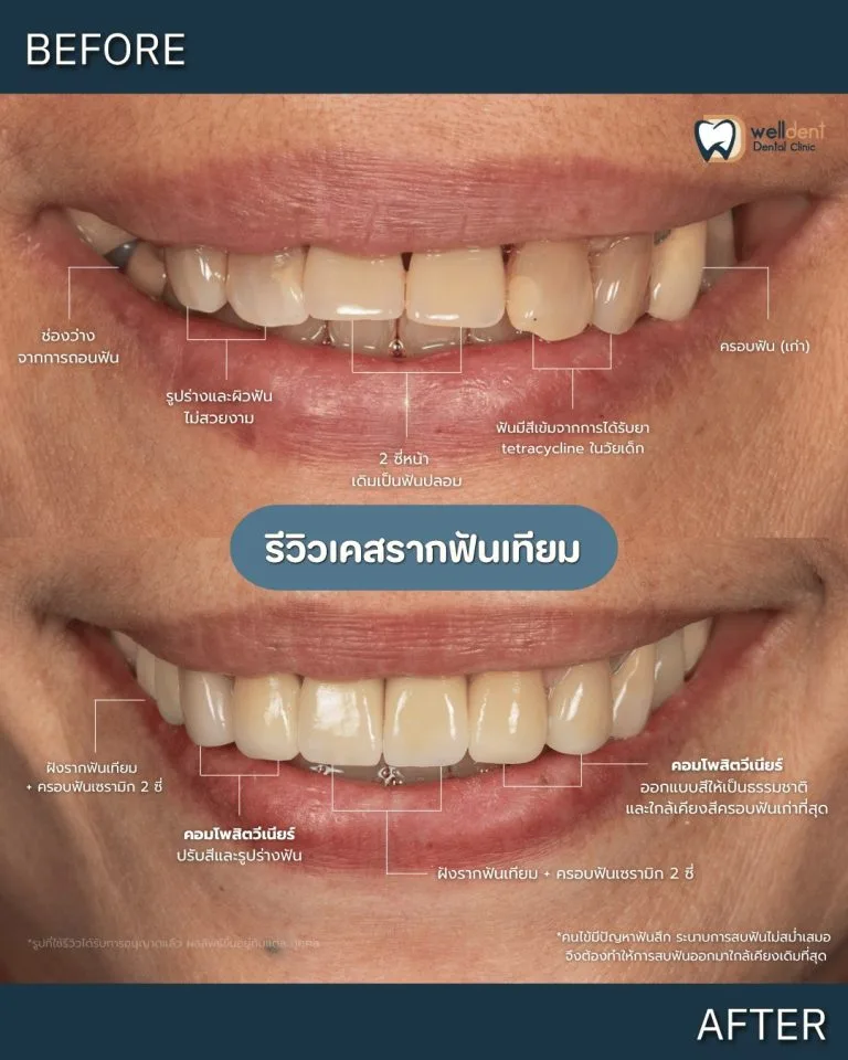 รีวิวผลการรักษา รากฟันเทียม Nuvo, Neodent และ Straumann ต่างกันอย่างไร? เลือกแบบไหนให้เหมาะกับตัวเอง