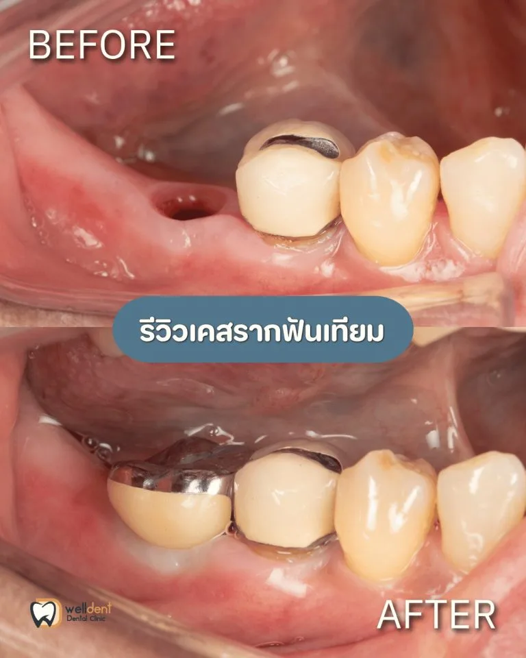 รีวิวผลการรักษา รากฟันเทียม Nuvo, Neodent และ Straumann ต่างกันอย่างไร? เลือกแบบไหนให้เหมาะกับตัวเอง