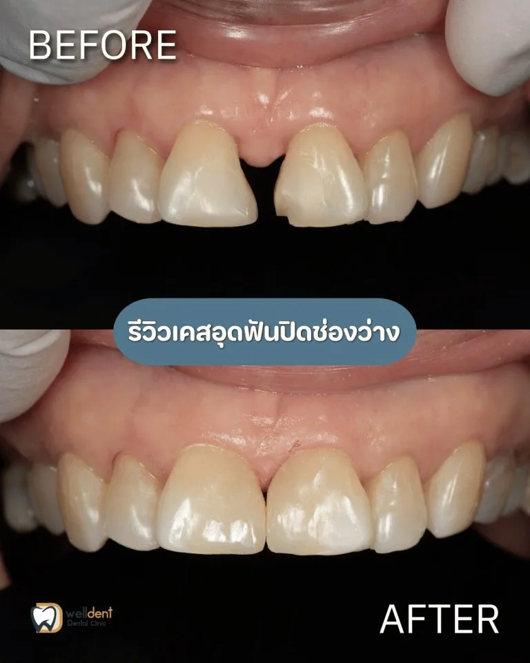 รีวิวผลการรักษา ปิดฟันห่างโดยไม่ต้องจัดฟันได้ไหม? รู้จักการอุดปิดช่องว่าง พร้อมราคาและข้อควรรู้