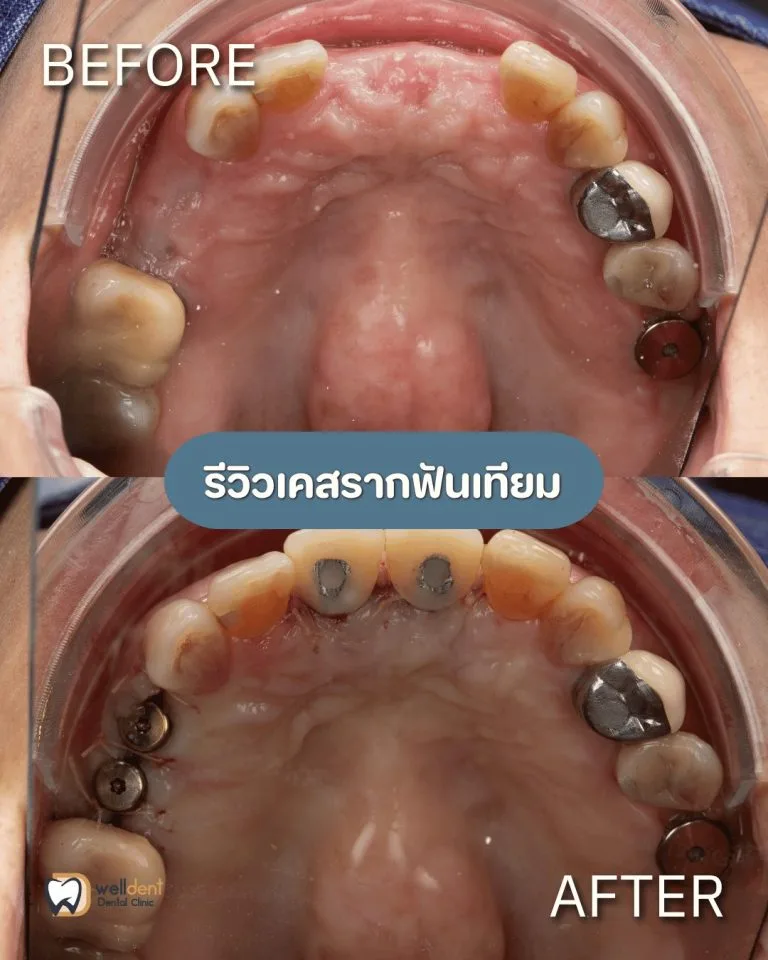 รีวิวผลลัพธ์ก่อน-หลัง Welldent Dental Clinic