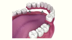 รากฟันเทียมรองรับฟันปลอม (Implant Overdenture) คืออะไร? ทางเลือกสำหรับผู้ที่ใส่ฟันปลอมแล้วไม่มั่นใจ