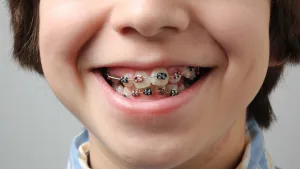ฟันซ้อน ฟันยื่น ฟันสบผิดปกติในเด็ก ควรเริ่มจัดฟันเมื่ออายุเท่าไร ?