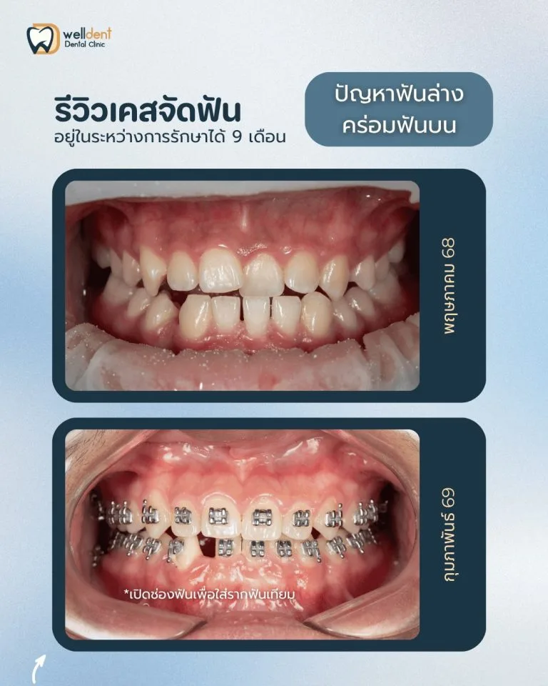 รีวิวผลการรักษา ราคาจัดฟันแบบโลหะ เริ่มต้นเท่าไร? ค่าใช้จ่ายในการจัดฟันที่ Welldent Dental Clinic มีอะไรบ้าง
