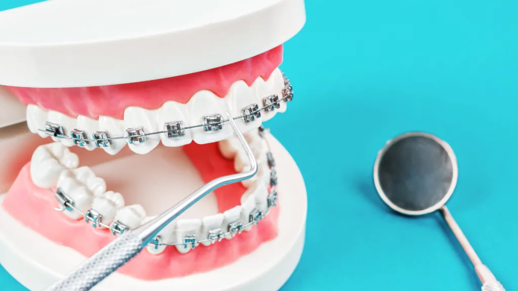 ราคาจัดฟันแบบโลหะ เริ่มต้นเท่าไร? ค่าใช้จ่ายในการจัดฟันที่ Welldent Dental Clinic มีอะไรบ้าง