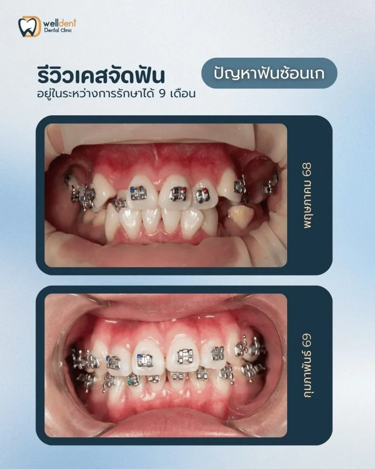 รีวิวผลการรักษา ราคาจัดฟันแบบโลหะ เริ่มต้นเท่าไร? ค่าใช้จ่ายในการจัดฟันที่ Welldent Dental Clinic มีอะไรบ้าง