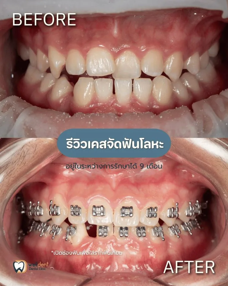 รีวิวผลการรักษา ราคาจัดฟันแบบโลหะ เริ่มต้นเท่าไร? ค่าใช้จ่ายในการจัดฟันที่ Welldent Dental Clinic มีอะไรบ้าง