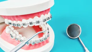 ราคาจัดฟันแบบโลหะ เริ่มต้นเท่าไร? ค่าใช้จ่ายในการจัดฟันที่ Welldent Dental Clinic มีอะไรบ้าง