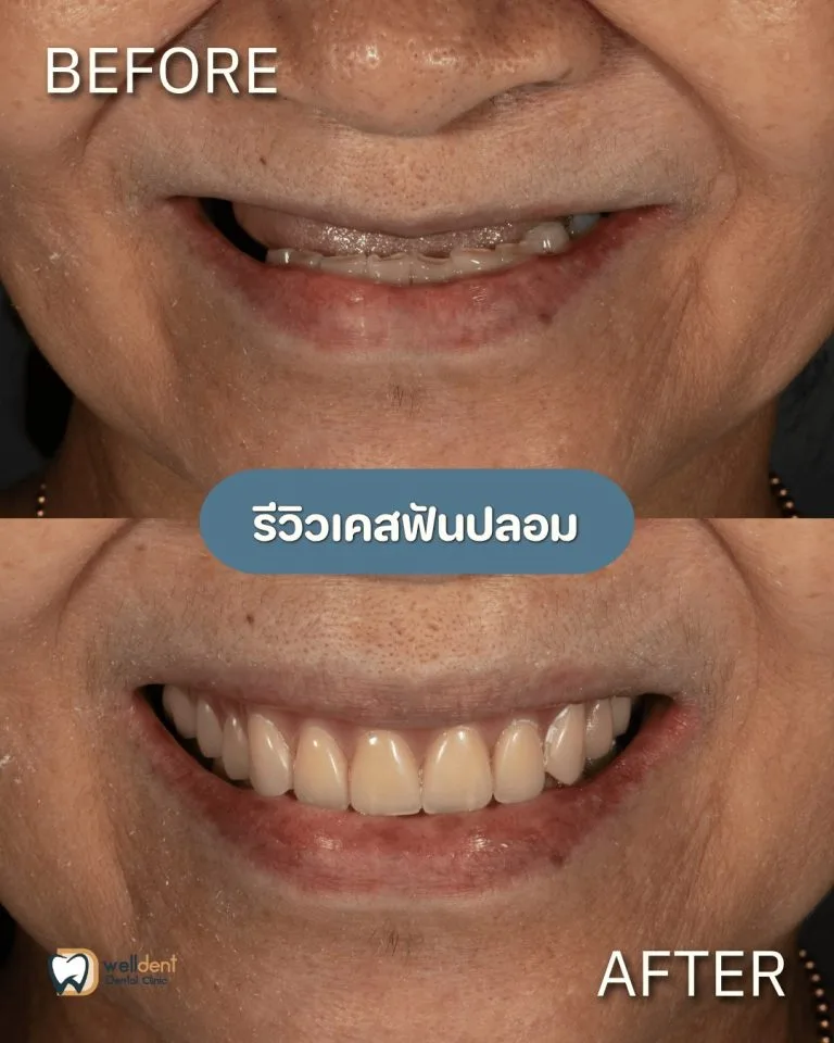 รีวิวผลการรักษา ฟันปลอมมีกี่ชนิด? เลือกแบบไหนดีให้เหมาะกับคุณ