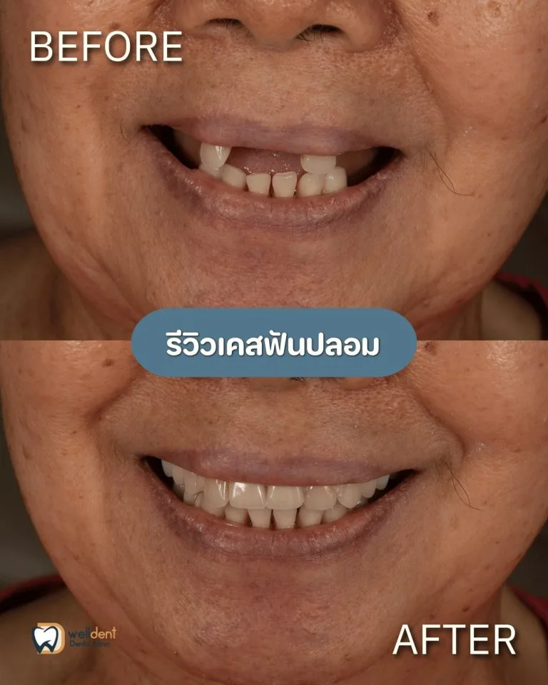 รีวิวผลการรักษา ฟันปลอมมีกี่ชนิด? เลือกแบบไหนดีให้เหมาะกับคุณ