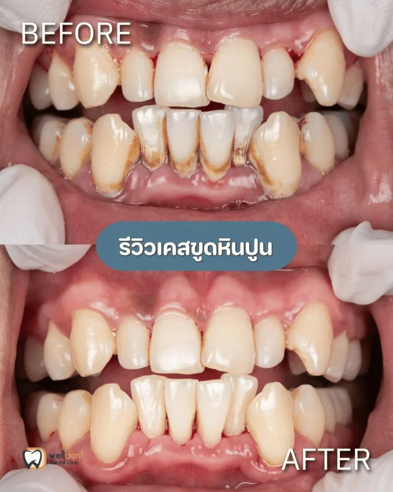 รีวิวผลการรักษา ขูดหินปูน ควรทำบ่อยแค่ไหน และจำเป็นหรือไม่?