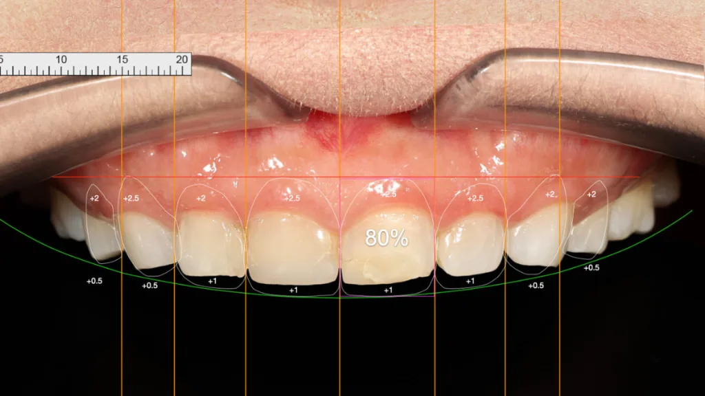 ออกแบบรอยยิ้ม (Smile Design) คืออะไร?