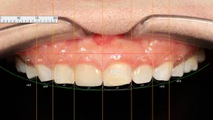 ออกแบบรอยยิ้ม (Smile Design) คืออะไร?