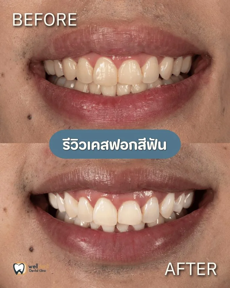 รีวิวผลการรักษา ฟอกสีฟันแล้วฟันขาวขึ้นจริงไหม? ฟอกสีฟันแบบไหนดี
