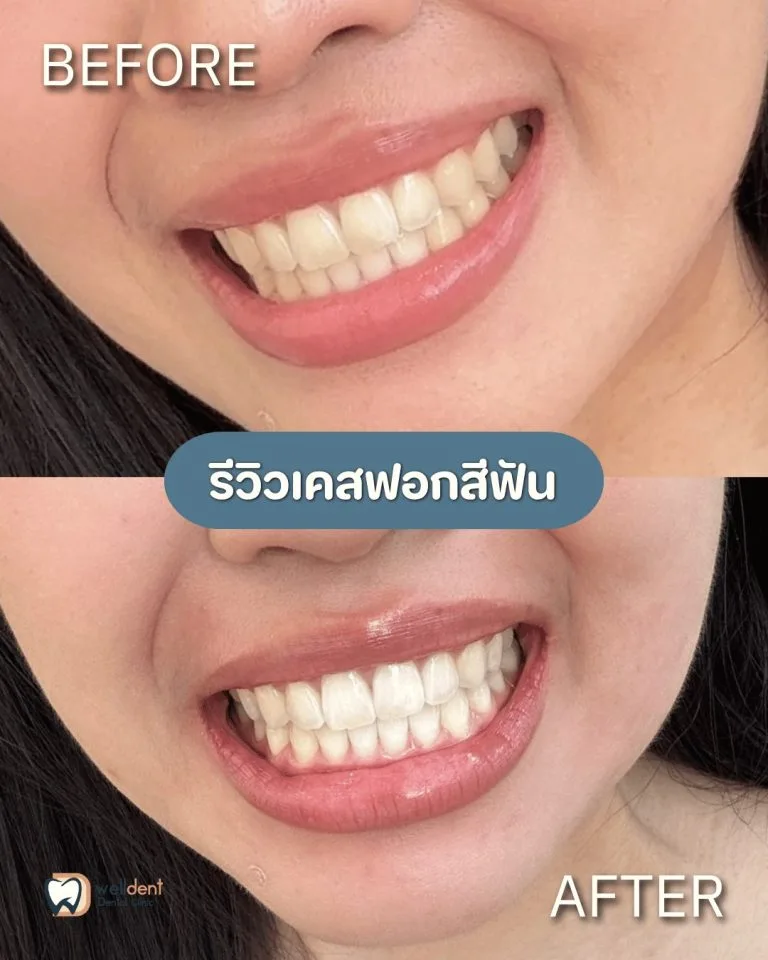 รีวิวผลการรักษา ฟอกสีฟันแล้วฟันขาวขึ้นจริงไหม? ฟอกสีฟันแบบไหนดี
