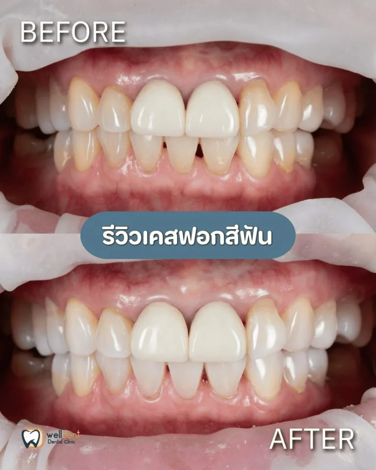 รีวิวผลการรักษา ฟอกสีฟันแล้วฟันขาวขึ้นจริงไหม? ฟอกสีฟันแบบไหนดี