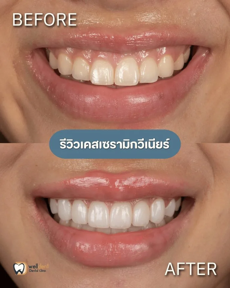 รีวิวผลลัพธ์ก่อน-หลัง Welldent Dental Clinic