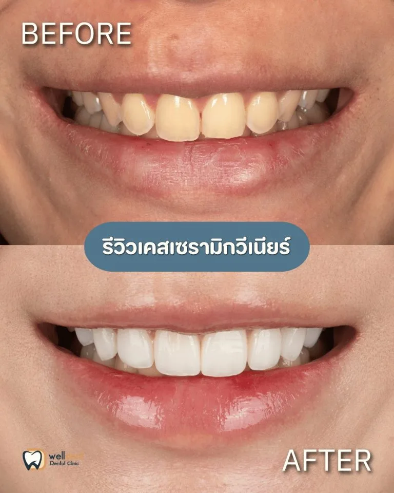 รีวิวผลการรักษา วีเนียร์ คืออะไร? เหมาะกับใคร ทำแล้วอยู่ได้กี่ปี?