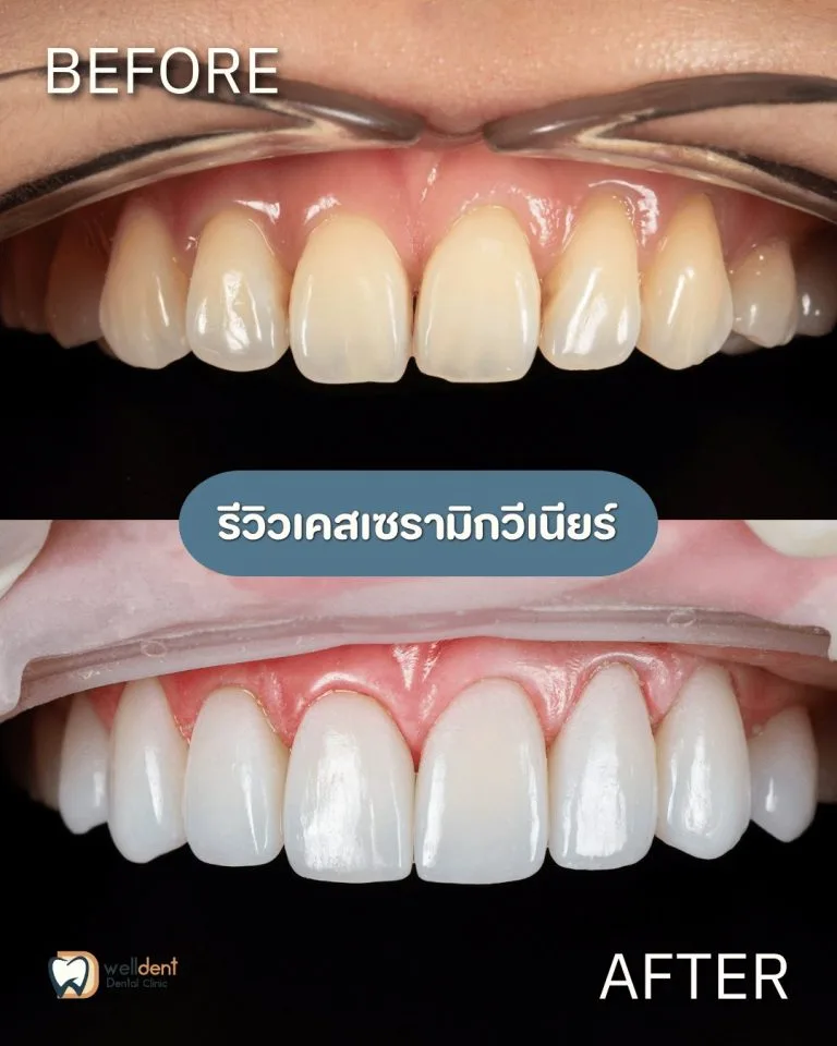 รีวิวผลการรักษา วีเนียร์ คืออะไร? เหมาะกับใคร ทำแล้วอยู่ได้กี่ปี?