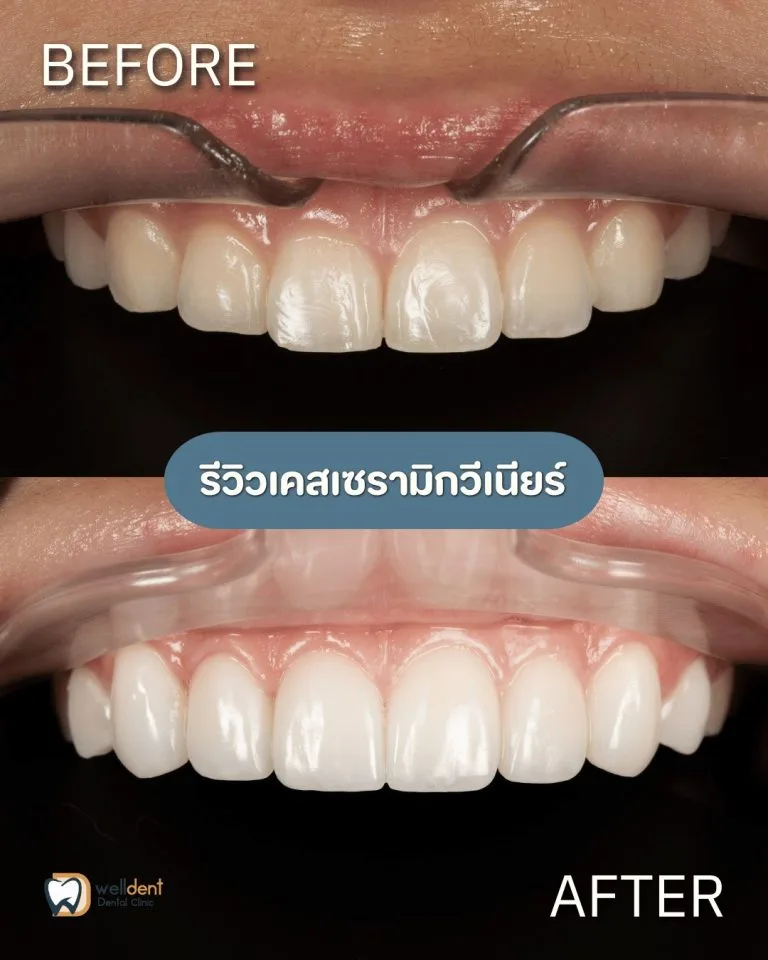 รีวิวผลการรักษา วีเนียร์ คืออะไร? เหมาะกับใคร ทำแล้วอยู่ได้กี่ปี?
