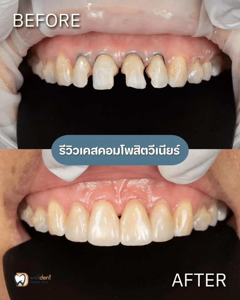 รีวิวผลการรักษา วีเนียร์ คืออะไร? เหมาะกับใคร ทำแล้วอยู่ได้กี่ปี?