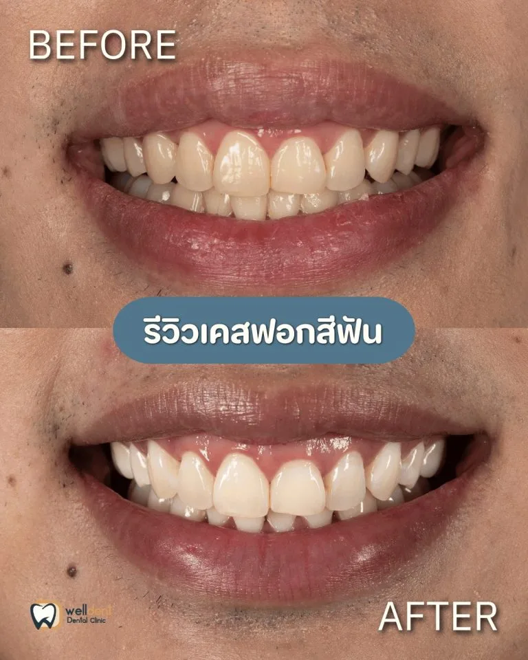 รีวิวผลลัพธ์ก่อน-หลัง Welldent Dental Clinic